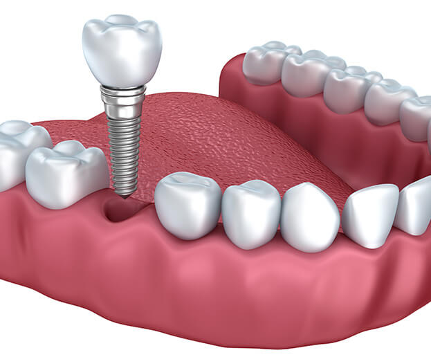 illustration of a dental implant